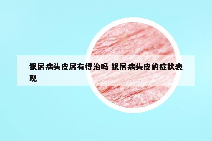 银屑病头皮屑有得治吗 银屑病头皮的症状表现