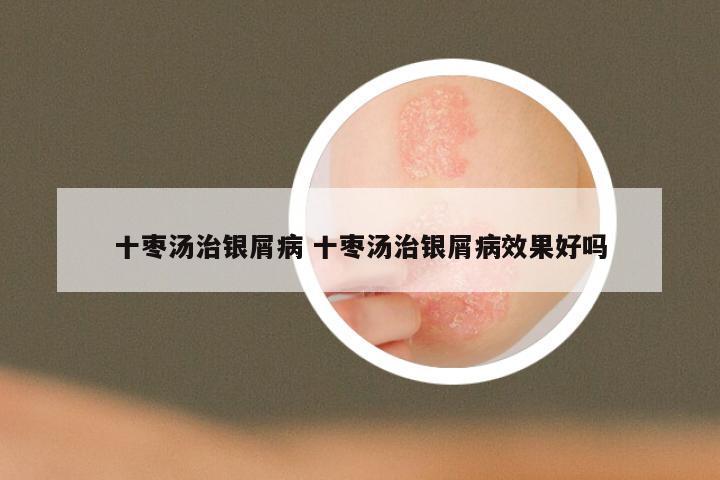 十枣汤治银屑病 十枣汤治银屑病效果好吗