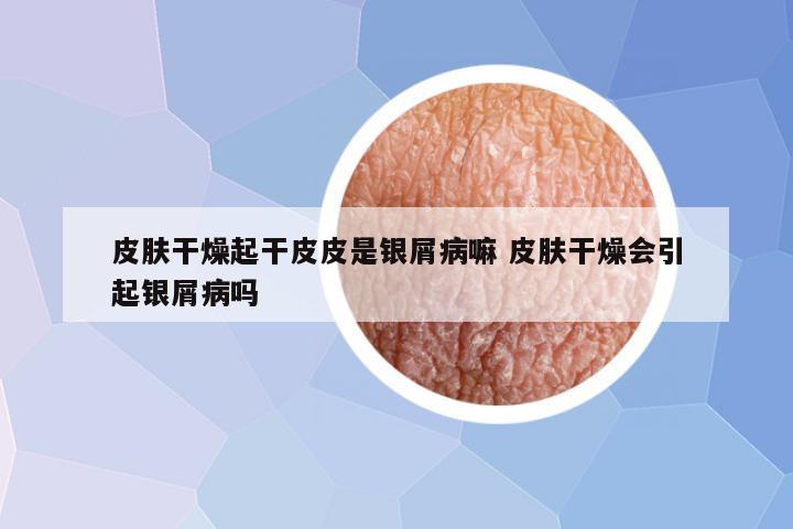 皮肤干燥起干皮皮是银屑病嘛 皮肤干燥会引起银屑病吗