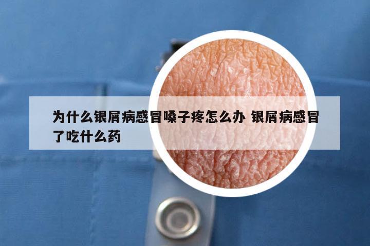 为什么银屑病感冒嗓子疼怎么办 银屑病感冒了吃什么药
