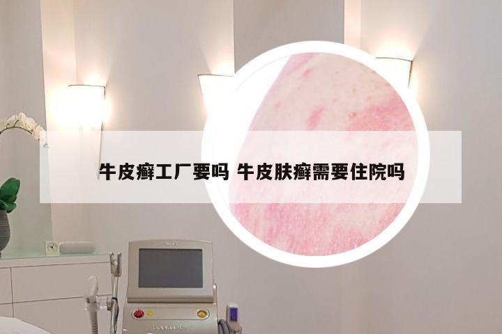 牛皮癣工厂要吗 牛皮肤癣需要住院吗