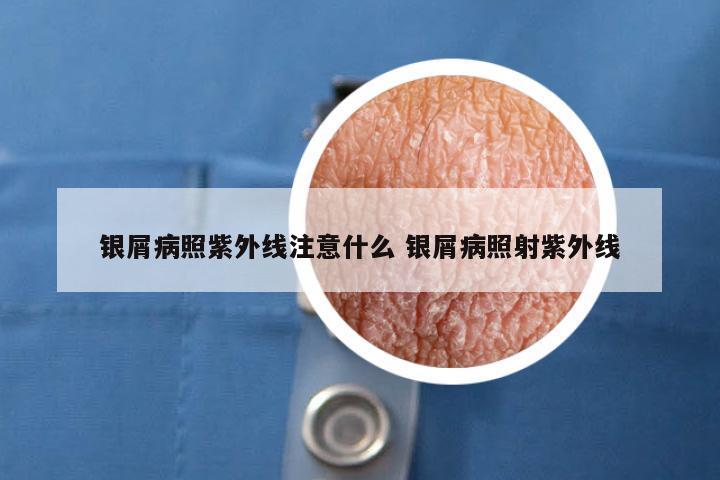 银屑病照紫外线注意什么 银屑病照射紫外线