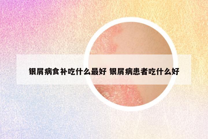 银屑病食补吃什么最好 银屑病患者吃什么好