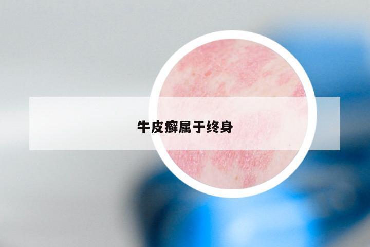 牛皮癣属于终身