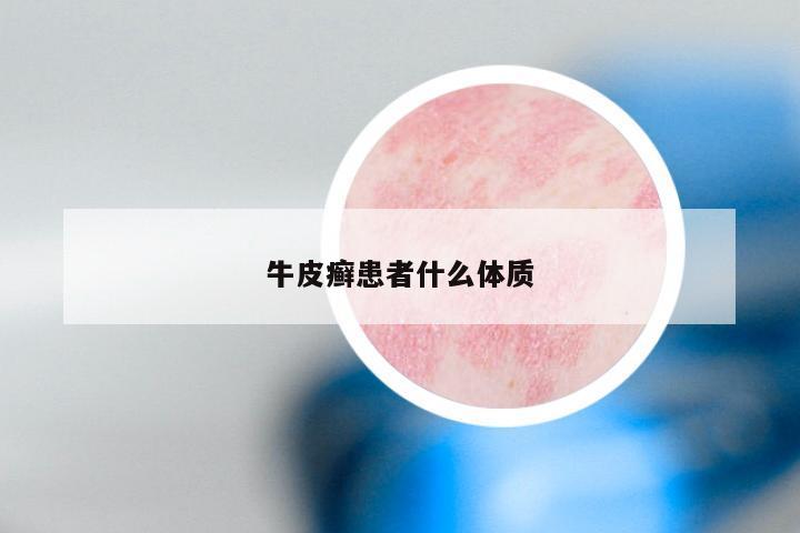 牛皮癣患者什么体质