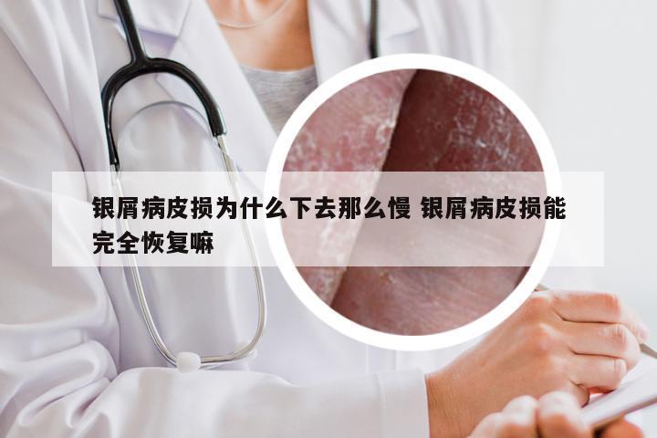 银屑病皮损为什么下去那么慢 银屑病皮损能完全恢复嘛