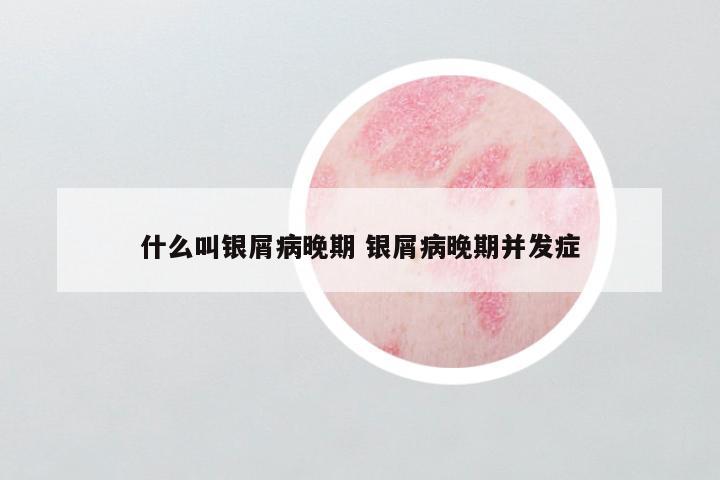 什么叫银屑病晚期 银屑病晚期并发症