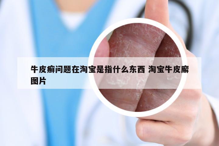 牛皮癣问题在淘宝是指什么东西 淘宝牛皮廨图片