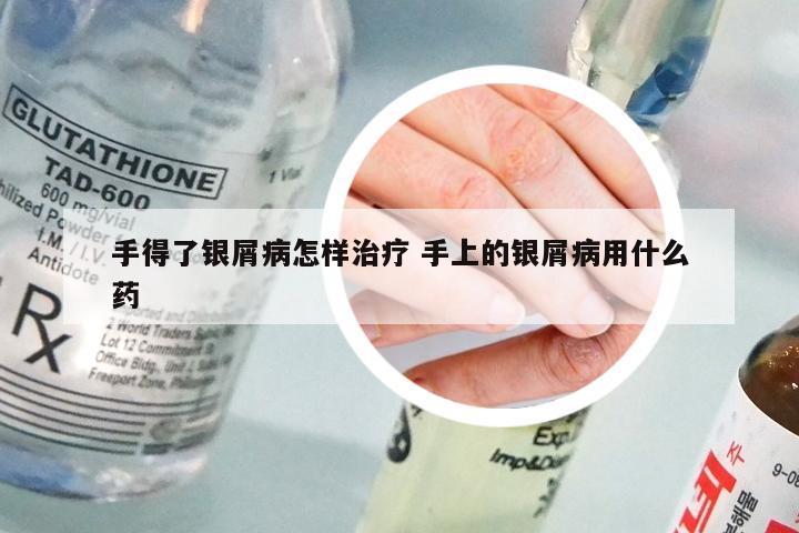 手得了银屑病怎样治疗 手上的银屑病用什么药