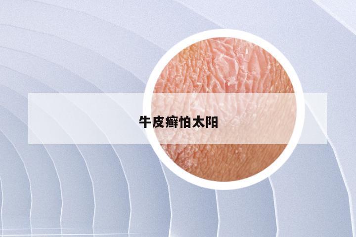 牛皮癣怕太阳