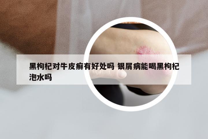黑枸杞对牛皮癣有好处吗 银屑病能喝黑枸杞泡水吗
