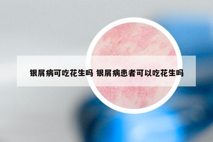 银屑病可吃花生吗 银屑病患者可以吃花生吗