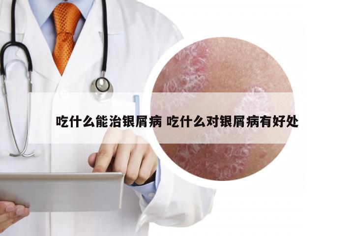 吃什么能治银屑病 吃什么对银屑病有好处
