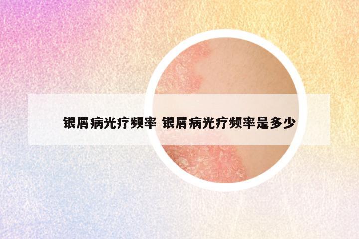 银屑病光疗频率 银屑病光疗频率是多少