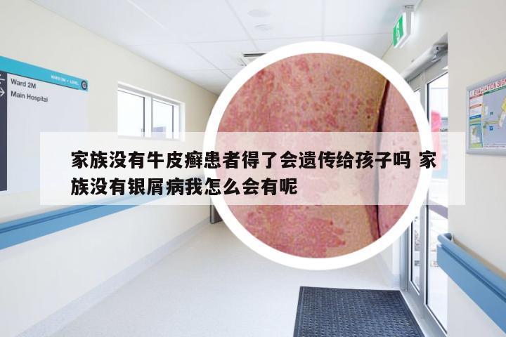 家族没有牛皮癣患者得了会遗传给孩子吗 家族没有银屑病我怎么会有呢