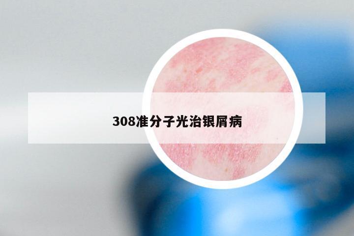 308准分子光治银屑病