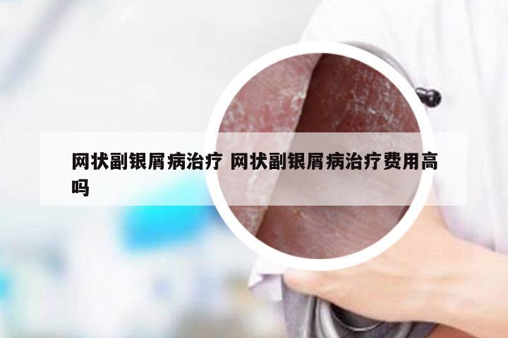 网状副银屑病治疗 网状副银屑病治疗费用高吗