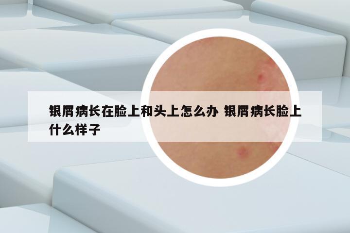 银屑病长在脸上和头上怎么办 银屑病长脸上什么样子