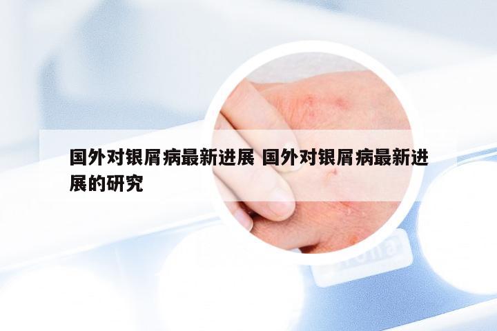 国外对银屑病最新进展 国外对银屑病最新进展的研究