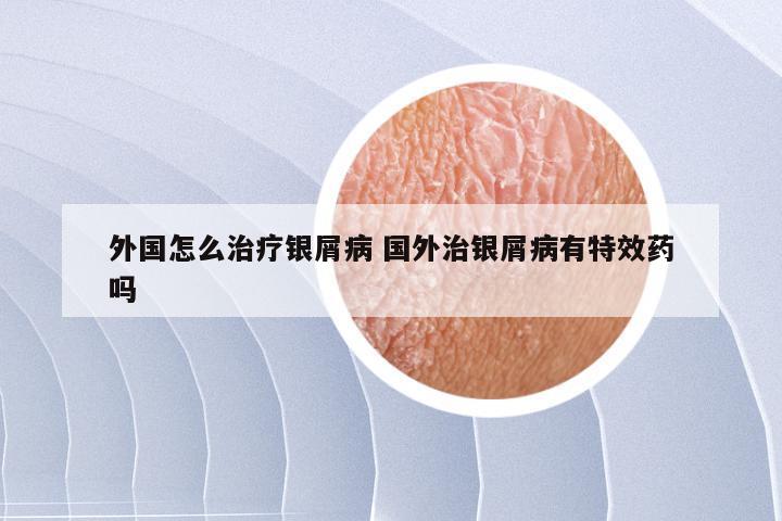 外国怎么治疗银屑病 国外治银屑病有特效药吗