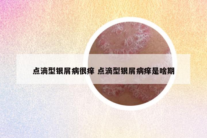 点滴型银屑病很痒 点滴型银屑病痒是啥期
