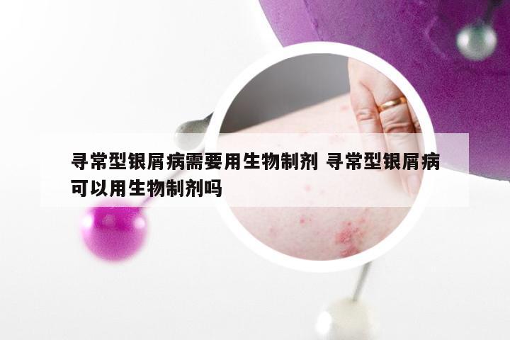 寻常型银屑病需要用生物制剂 寻常型银屑病可以用生物制剂吗