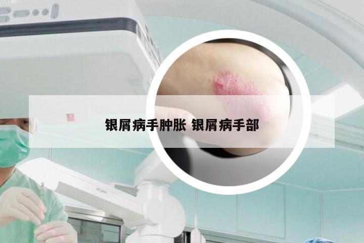 银屑病手肿胀 银屑病手部