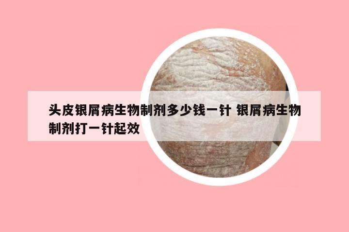 头皮银屑病生物制剂多少钱一针 银屑病生物制剂打一针起效