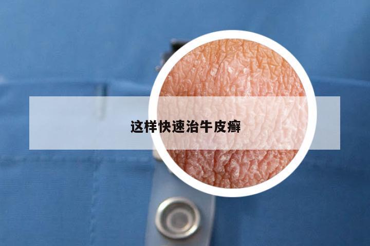 这样快速治牛皮癣