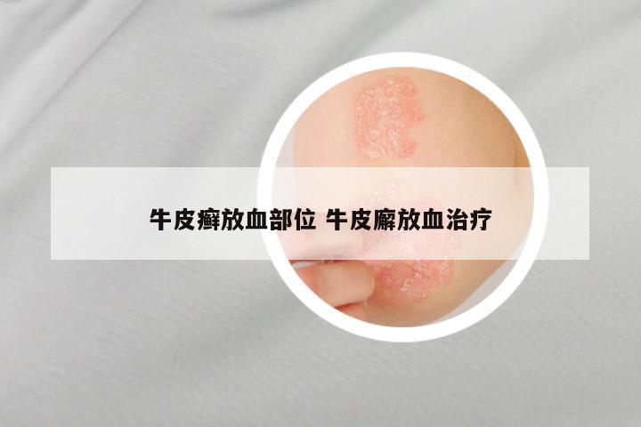 牛皮癣放血部位 牛皮廨放血治疗