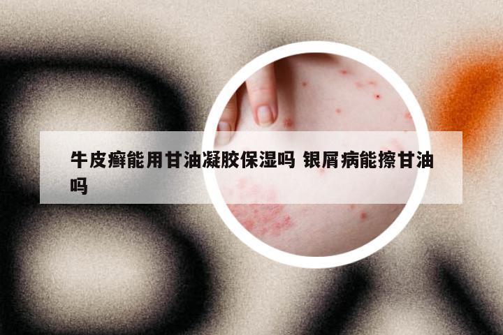 牛皮癣能用甘油凝胶保湿吗 银屑病能擦甘油吗