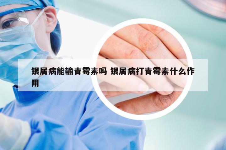 银屑病能输青霉素吗 银屑病打青霉素什么作用