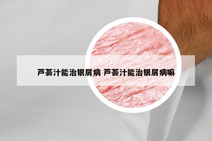 芦荟汁能治银屑病 芦荟汁能治银屑病嘛