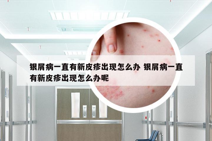 银屑病一直有新皮疹出现怎么办 银屑病一直有新皮疹出现怎么办呢