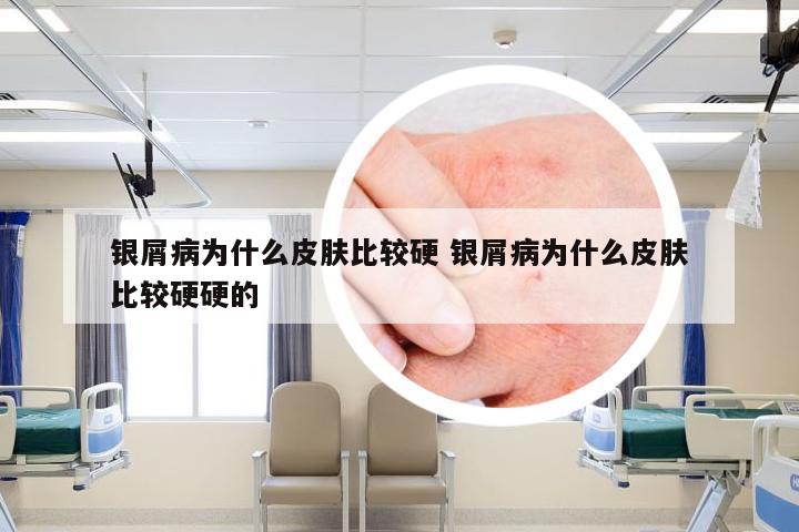 银屑病为什么皮肤比较硬 银屑病为什么皮肤比较硬硬的