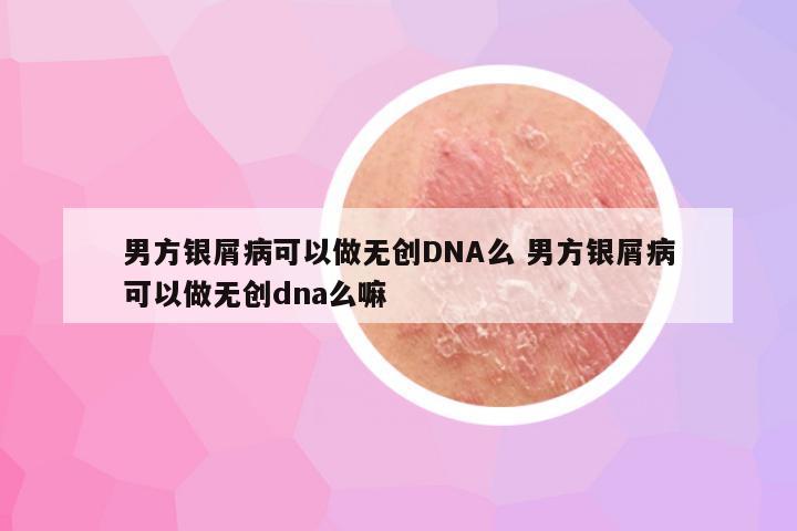 男方银屑病可以做无创DNA么 男方银屑病可以做无创dna么嘛