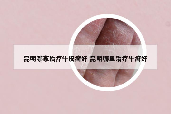 昆明哪家治疗牛皮癣好 昆明哪里治疗牛癣好
