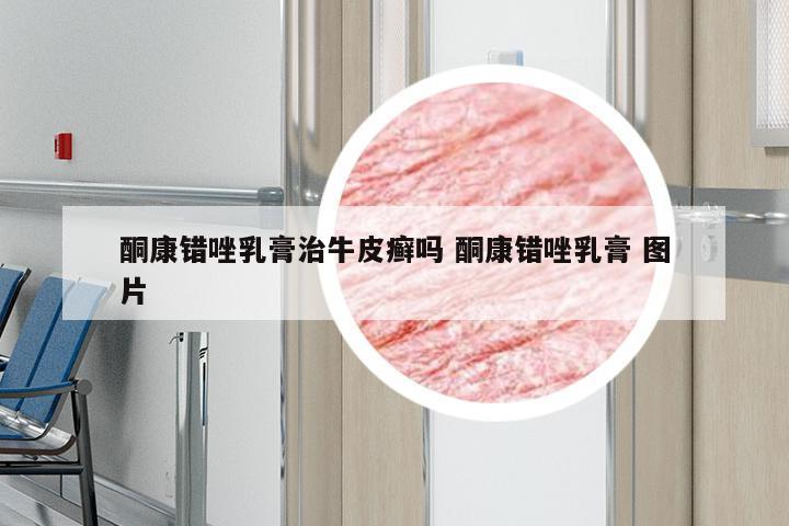 酮康错唑乳膏治牛皮癣吗 酮康错唑乳膏 图片