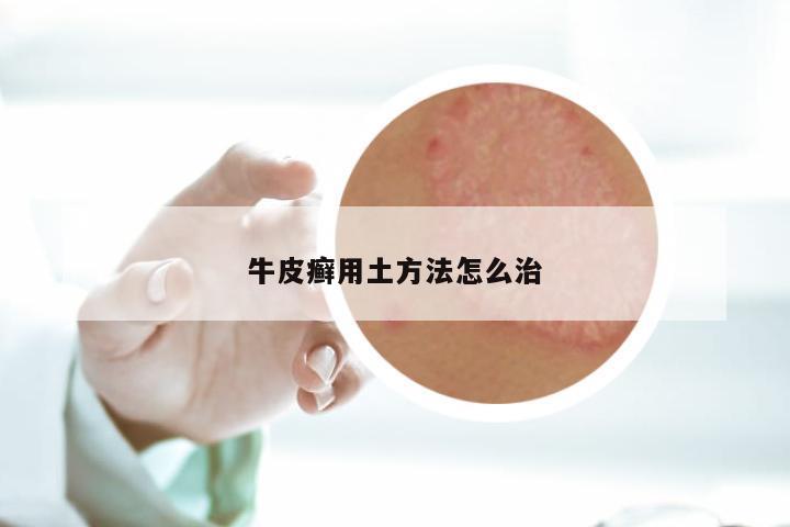牛皮癣用土方法怎么治