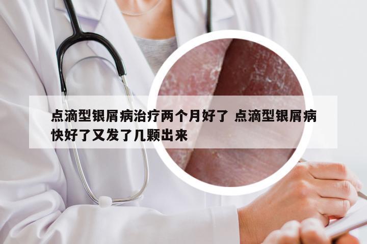 点滴型银屑病治疗两个月好了 点滴型银屑病快好了又发了几颗出来