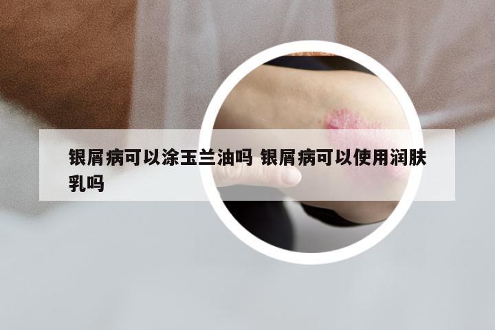 银屑病可以涂玉兰油吗 银屑病可以使用润肤乳吗