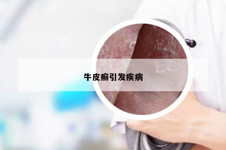 牛皮癣引发疾病