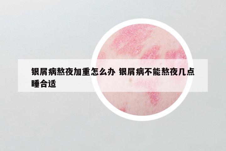银屑病熬夜加重怎么办 银屑病不能熬夜几点睡合适