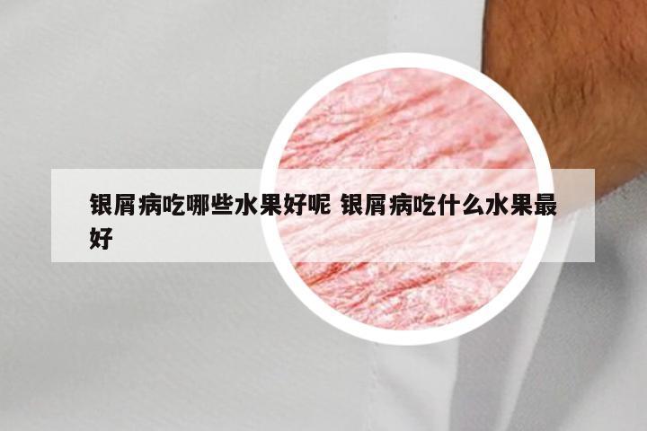 银屑病吃哪些水果好呢 银屑病吃什么水果最好