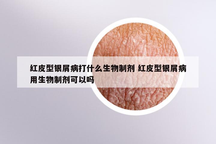 红皮型银屑病打什么生物制剂 红皮型银屑病用生物制剂可以吗