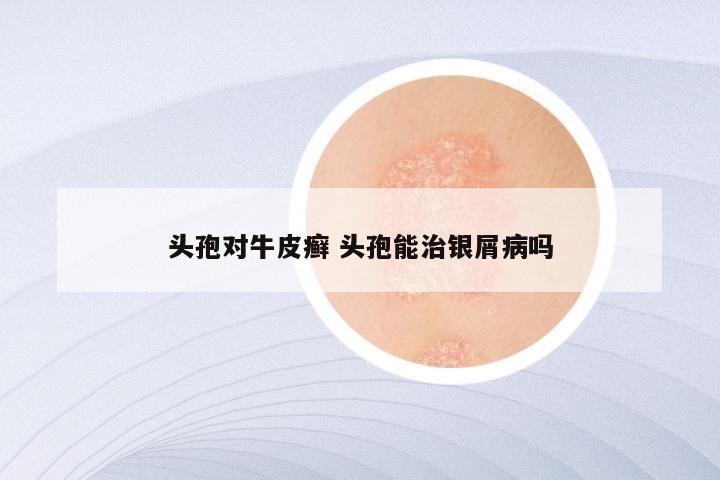 头孢对牛皮癣 头孢能治银屑病吗