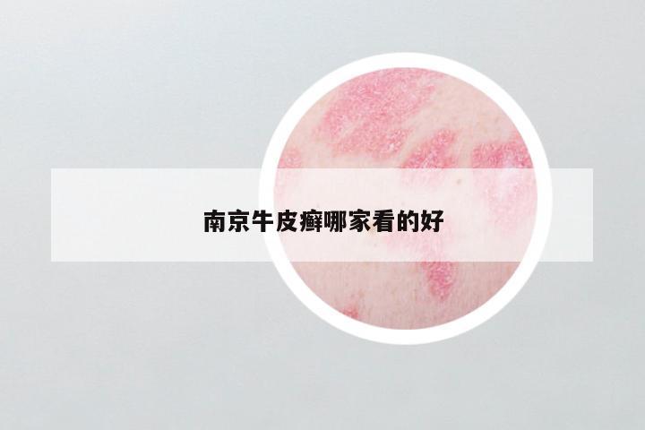 南京牛皮癣哪家看的好