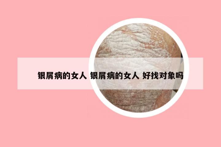 银屑病的女人 银屑病的女人 好找对象吗