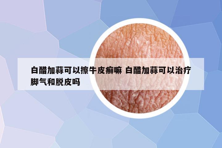 白醋加蒜可以擦牛皮癣嘛 白醋加蒜可以治疗脚气和脱皮吗