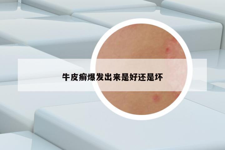 牛皮癣爆发出来是好还是坏